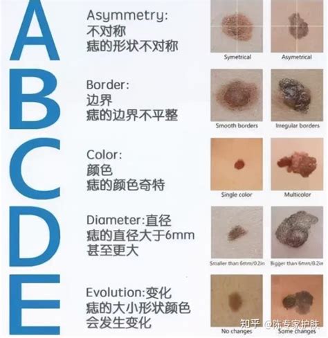 有問題的痣|痣有4種顏色，出現在「手腳這邊」的痣可能是皮膚。